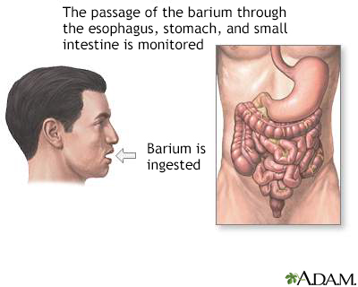 Barium ingestion - Illustration Thumbnail                      