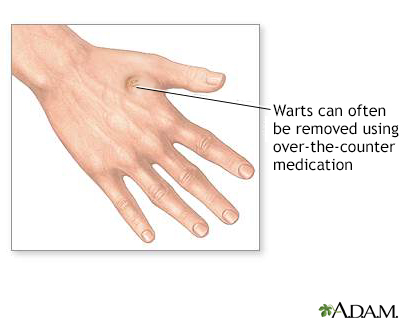 Wart removal - Illustration Thumbnail                      