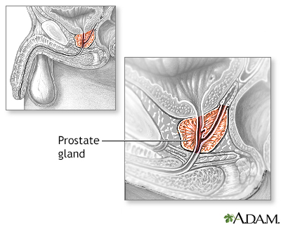 Transurethral Resection of the Prostate (TURP) - Series - Presentation Thumbnail                    