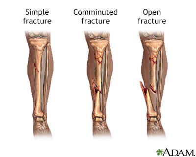 Bone fracture repair - series - Presentation Thumbnail                    