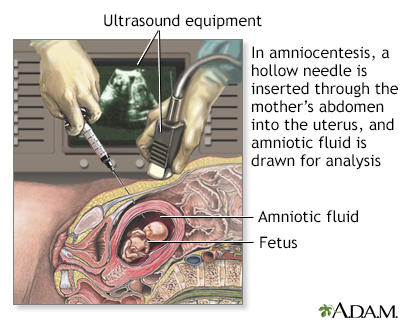 Amniocentesis - Illustration Thumbnail                      
