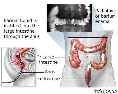 Barium enema - Illustration Thumbnail                      