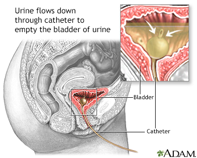 Bladder catheterization, female - Illustration Thumbnail                      