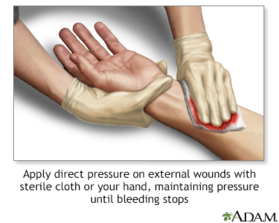 Stopping bleeding with direct pressure - Illustration Thumbnail                      