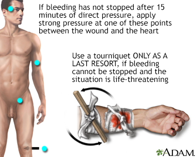 Stopping bleeding with a tourniquet - Illustration Thumbnail                      