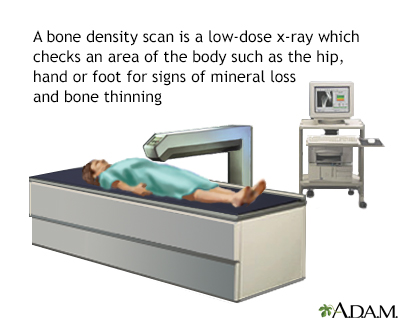 Bone density scan - Illustration Thumbnail                      