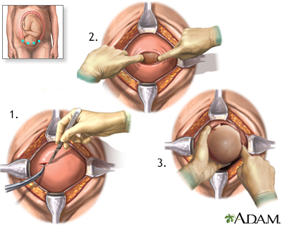 Cesarean section - Illustration Thumbnail                      