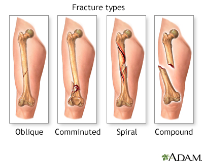 Fracture types (1) - Illustration Thumbnail                      