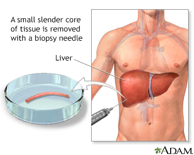 Liver biopsy - Illustration Thumbnail                      