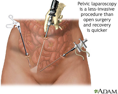 Pelvic laparoscopy - Illustration Thumbnail                      