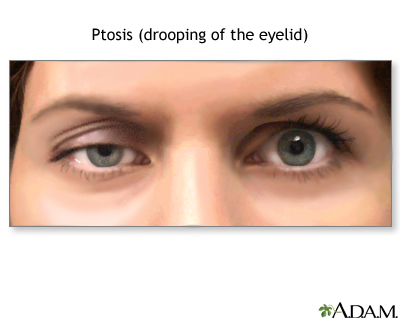 Ptosis - drooping of the eyelid - Illustration Thumbnail                      