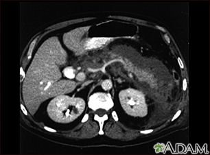 Pancreatitis, acute - CT scan - Illustration Thumbnail                      