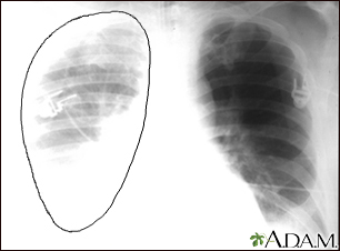 Aortic rupture - chest X-ray - Illustration Thumbnail                      