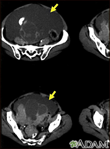 Ascites with ovarian cancer - CT scan - Illustration Thumbnail                      