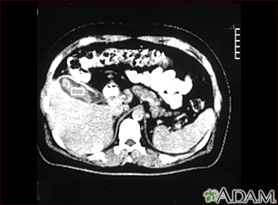 Cholecystitis, CT scan - Illustration Thumbnail                      