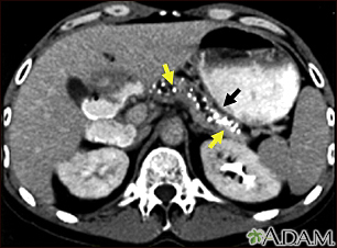 Pancreatitis, chronic - CT scan - Illustration Thumbnail                      
