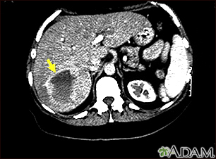 Hemangioma - CT scan - Illustration Thumbnail                      