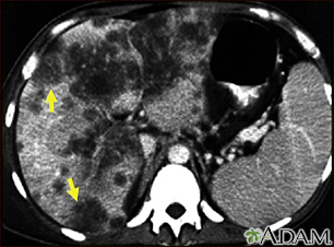 Hepatocellular cancer - CT scan - Illustration Thumbnail                      