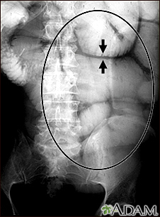 Ileus - X-ray of bowel distension - Illustration Thumbnail                      