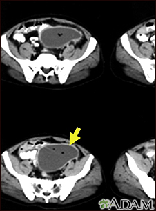 Intra-abdominal abscess - CT scan - Illustration Thumbnail                      