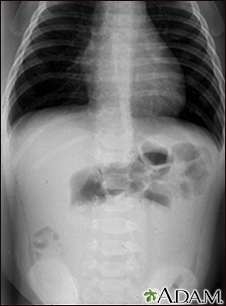 Intussusception - X-ray - Illustration Thumbnail                      