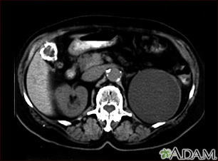 Kidney cyst with gallstones - CT scan - Illustration Thumbnail                      