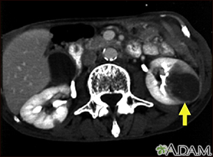 Kidney metastases - CT scan - Illustration Thumbnail                      