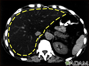 Fatty liver - CT scan - Illustration Thumbnail                      