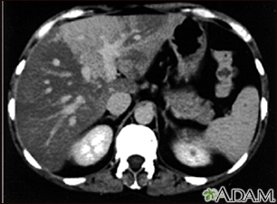 Liver with disproportional fattening - CT scan - Illustration Thumbnail                      