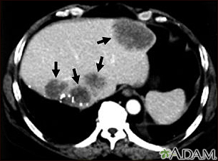 Liver metastases, CT scan - Illustration Thumbnail                      