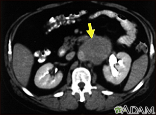 Lymph node metastases, CT scan - Illustration Thumbnail                      