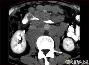 Lymphoma, malignant - CT scan - Illustration Thumbnail                      