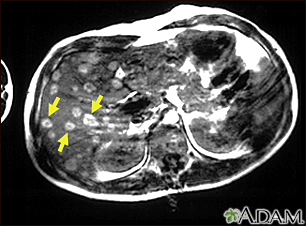 Melanoma of the liver - MRI scan - Illustration Thumbnail                      