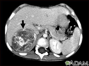 Neuroblastoma in the liver - CT scan - Illustration Thumbnail                      