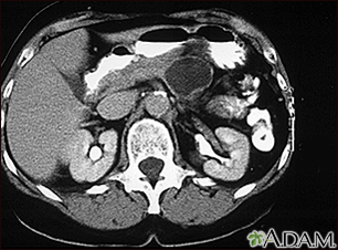 Pancreatic, cystic adenoma - CT scan - Illustration Thumbnail                      
