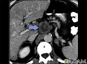 Pancreatic cancer, CT scan - Illustration Thumbnail                      