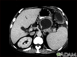 Pancreatic pseudocyst - CT scan - Illustration Thumbnail                      
