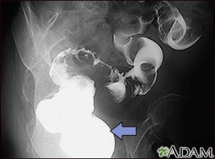 Sigmoid colon cancer - X-ray - Illustration Thumbnail                      