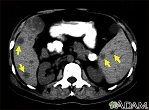 Spleen metastasis - CT scan - Illustration Thumbnail                      