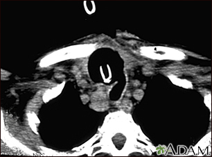 Thyroid cancer - CT scan - Illustration Thumbnail                      