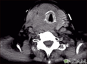 Thyroid cancer - CT scan - Illustration Thumbnail                      