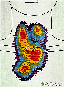 Thyroid enlargement - scintiscan - Illustration Thumbnail                      