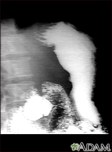 Stomach ulcer, X-ray - Illustration Thumbnail                      
