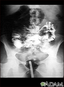 Volvulus - X-ray - Illustration Thumbnail                      
