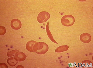 Red blood cells, sickle cell - Illustration Thumbnail                      