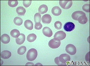 Megaloblastic anemia - view of red blood cells - Illustration Thumbnail                      