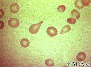 Red blood cells, tear-drop shape - Illustration Thumbnail                      