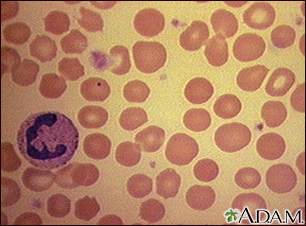 Red blood cells - spherocytosis - Illustration Thumbnail                      