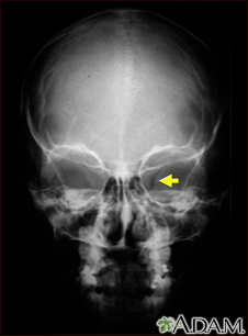 Neurofibromatosis I - enlarged optic foramen - Illustration Thumbnail                      