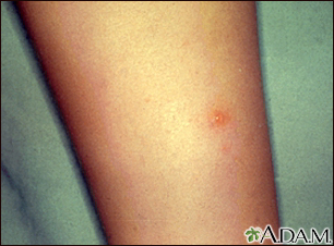 Chickenpox - lesion on the leg - Illustration Thumbnail                      